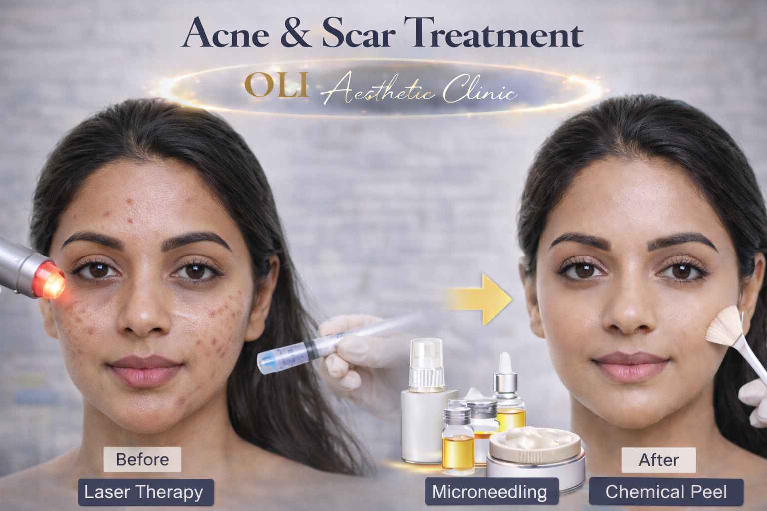 acne scar treatment